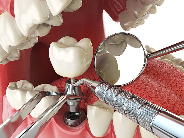 Best Emergency Root Canal Treatment in Brooklyn, IA